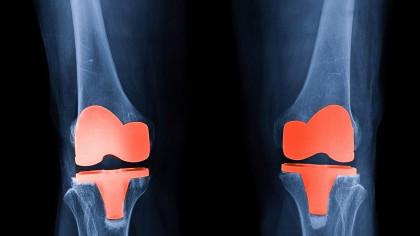 physiotherapy for joint replacement