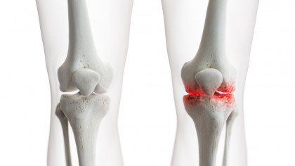 physiotherapy for osteoporosis and osteopenia